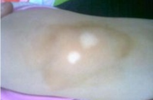 白癜风图片 白癜风图片