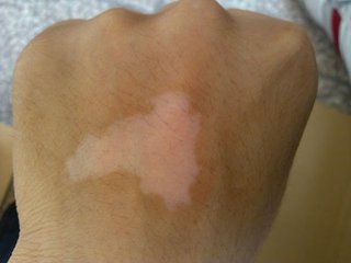 白癜风图片 白癜风症状图片