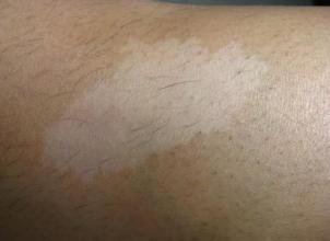 白癜风图片 白癜风症状图片