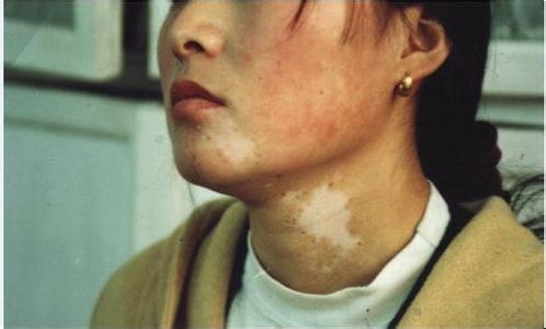 白癜风图片 白癜风图片